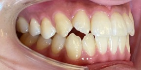 インビザライン症例ビフォア1