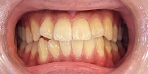 インビザライン症例ビフォア2