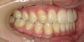 インビザライン症例アフター1
