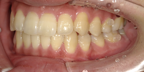 インビザライン症例アフター3