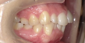 インビザライン症例ビフォア1