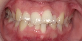 インビザライン症例ビフォア2