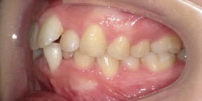 インビザライン症例ビフォア3