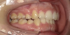 インビザライン症例アフター1