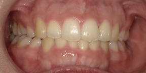 インビザライン症例アフター2