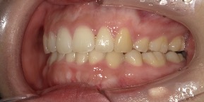 インビザライン症例アフター3