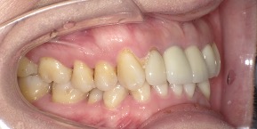 インビザライン症例ビフォア1