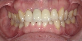 インビザライン症例ビフォア2