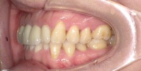 インビザライン症例ビフォア3