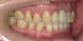インビザライン症例アフター1