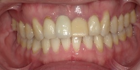 インビザライン症例アフター2