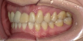 インビザライン症例アフター3