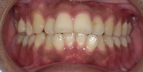 インビザライン症例ビフォア2