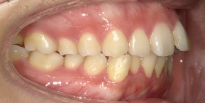 インビザライン症例ビフォア1