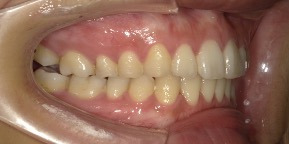 インビザライン症例アフター1