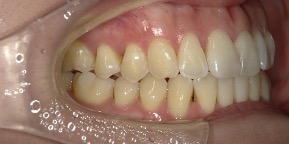 インビザライン症例アフター1