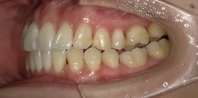 インビザライン症例アフター3
