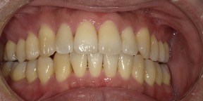インビザライン症例アフター2