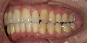 インビザライン症例アフター3
