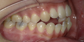 インビザライン症例ビフォア1