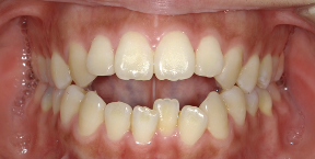 インビザライン症例ビフォア2