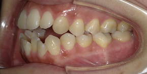 インビザライン症例ビフォア3