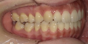 インビザライン症例アフター1