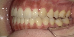 インビザライン症例アフター3