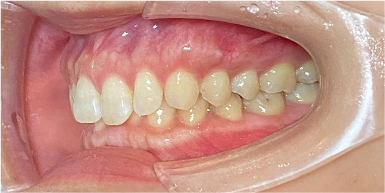 インビザライン症例ビフォア3