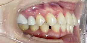 インビザライン症例ビフォア1