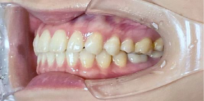 インビザライン症例ビフォア3