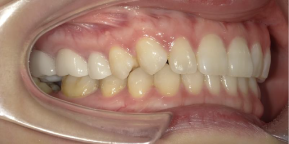 インビザライン症例アフター1