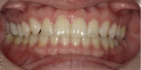 インビザライン症例アフター2