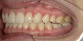 インビザライン症例アフター3